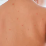 Cos’è la varicella : cause e sintomi