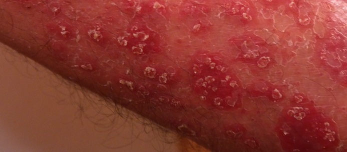 Dermatite: che cos’è