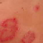 Dermatite atopica bambini : cause e sintomi