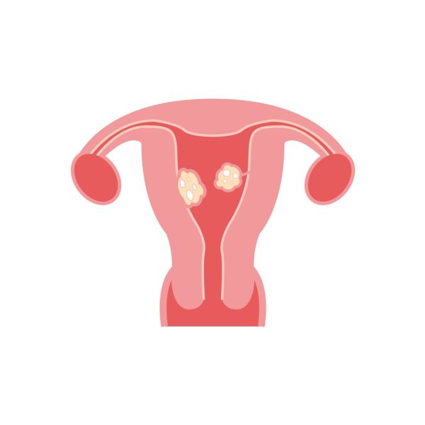 Fibromi uterini : quali sono sintomi e le cause
