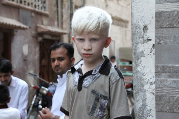 Cos’è l’ albinismo? Cause e sintomi