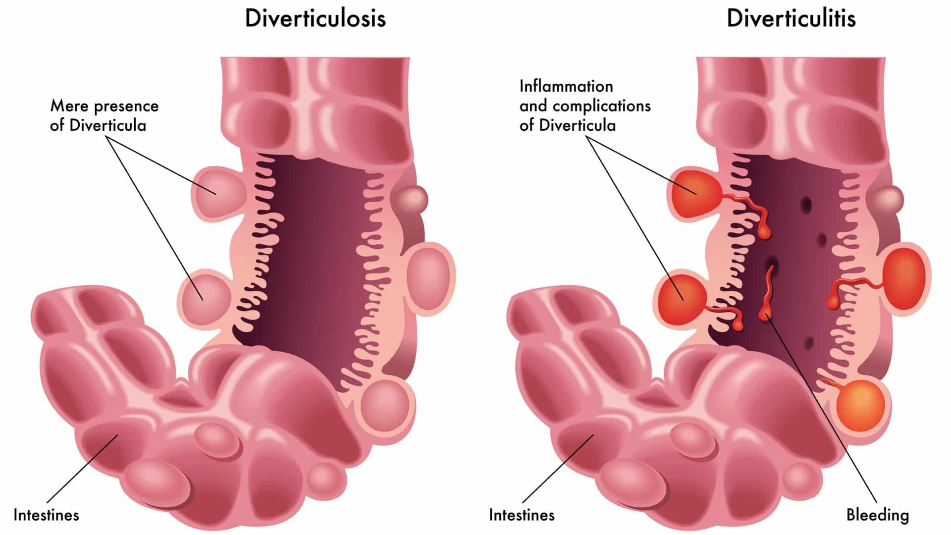 Occlusione intestinale